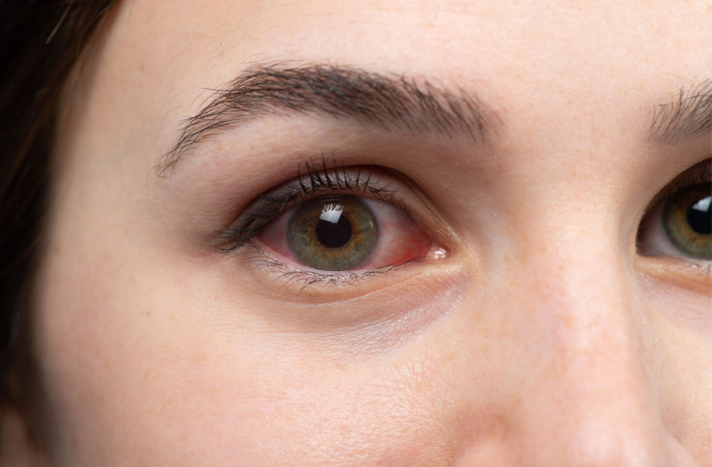 A close-up of a woman with a red eye caused by dry eye