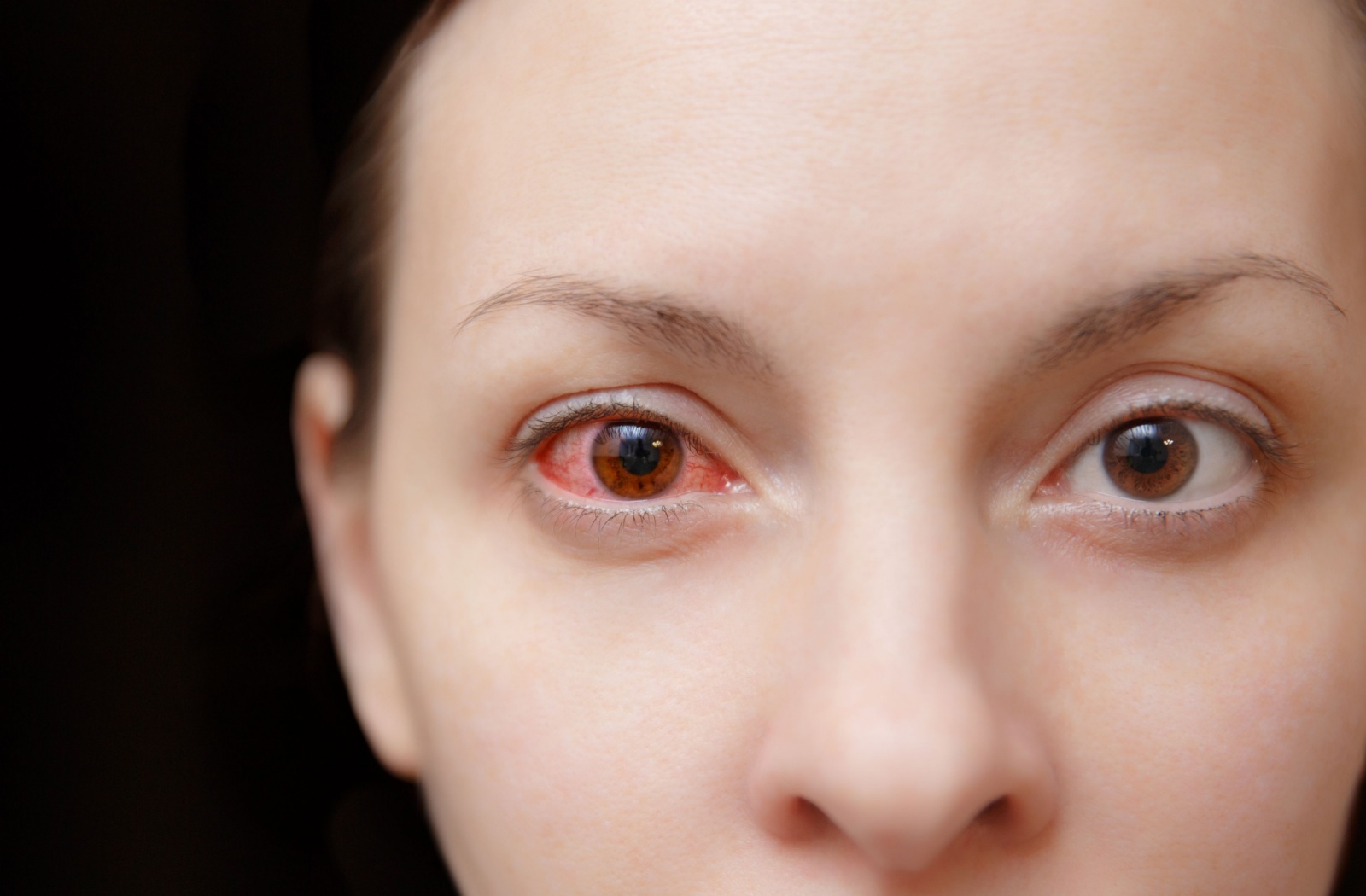 A woman looks at the camera, one of her eyes is red and inflamed with pink eye