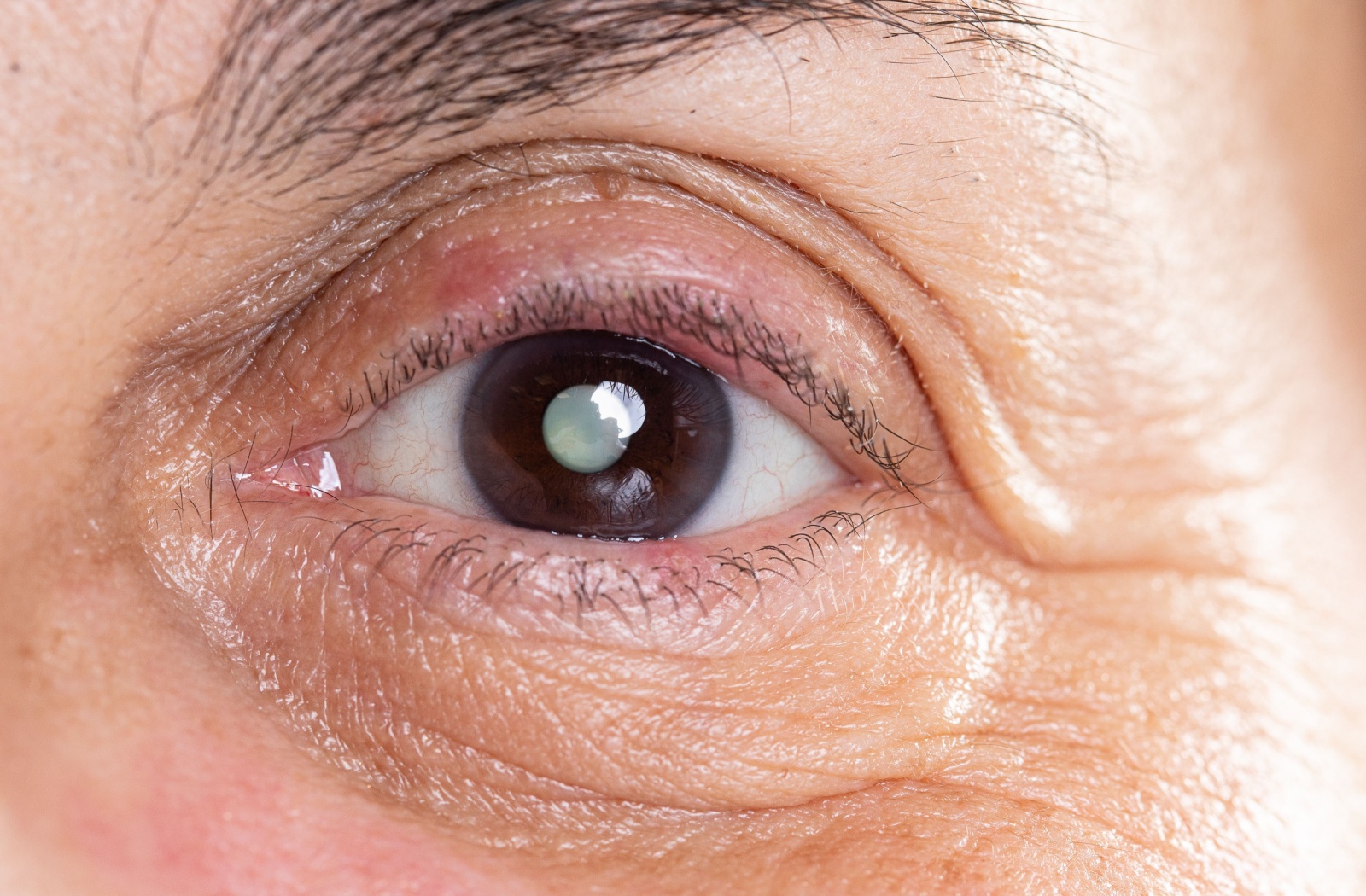 A close-up image of an eye developing a cataract.
